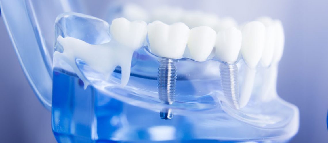 The image shows a dental implant model with a transparent blue lower jaw and white teeth, demonstrating the mechanics of dental implants in dentistry.