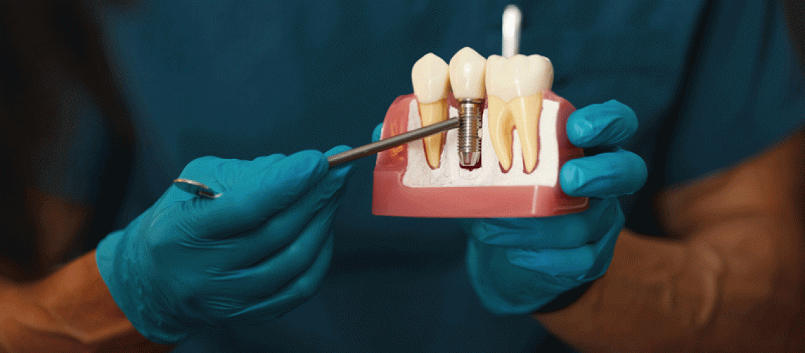 Dentist holding dental implant, artificial tooth roots into jaw, root canal of dental treatment, gum disease, teeth model for dentist.