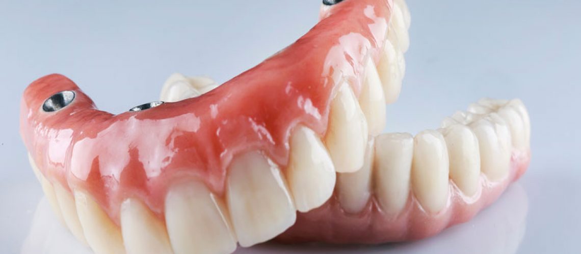 a full mouth dental implants model.