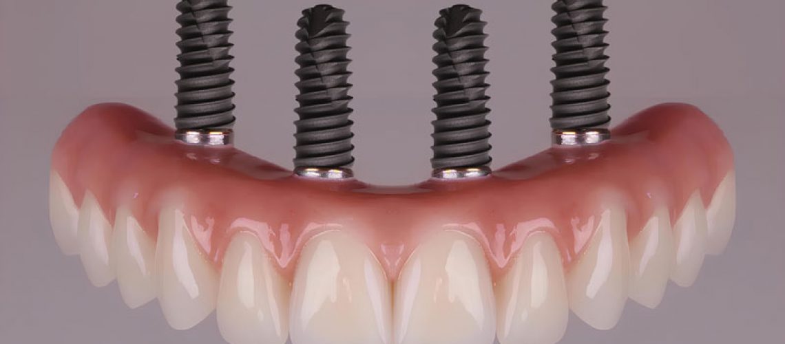 a full arch of teeth with 4 implants attached to the teeth