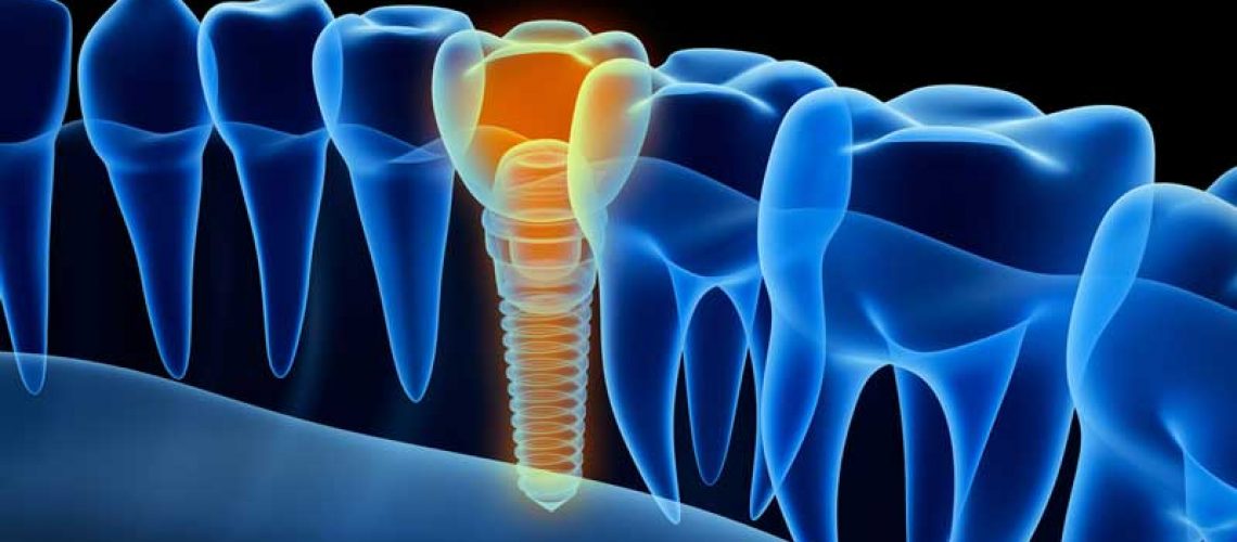 a digital graphic of a placed dental implant